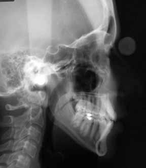 The conservative treatment of Class I malocclusion with maxillary transverse deficiency and anterior teeth crowding A B FigurE 4 - Initial lateral cephalometric radiograph (A) and cephalometric