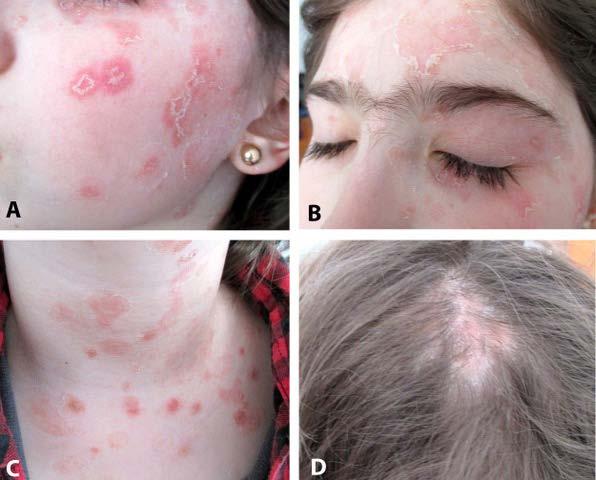 FIGURE 1. Erythematous scaly plaques scattered on the face (A and B), neck and the presternal area (C), and on the scalp (D).