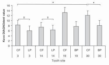 Figure 1. Hypomineralization of pit and fissure sites of the first permanent molars. No. 19 CF and 30 CF have significantly higher hypomineralization than all other sites (P<.001, except for P<.005).
