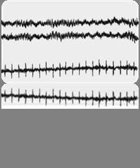 Normal Polysomnograph EEG