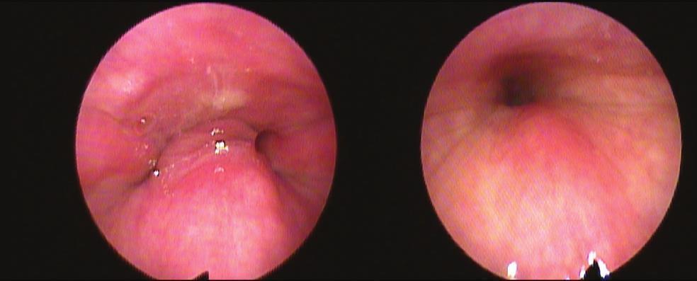 Sleep endoscopy Should it be routinely performed prior to adenotonsillectomy?