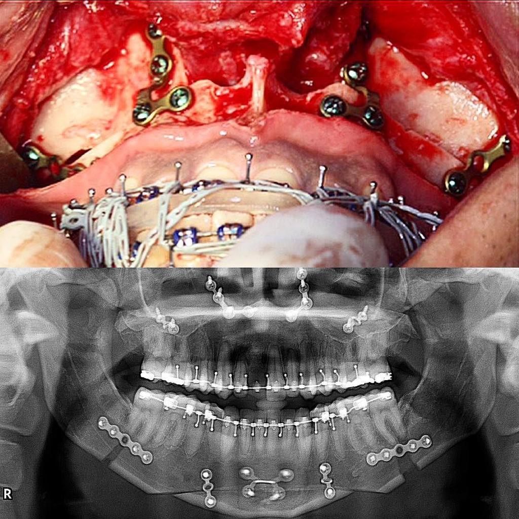 Oromaxillofacial procedures surgical advancement of the midface to enlarge the upper airway Le Fort II or Le Fort III procedure (internal or external distraction devices) substantially reduced the