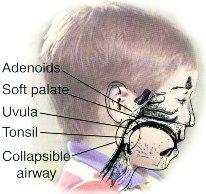 Enlarged Adenoids and Their Symptoms Breathing through the mouth instead of the nose most of the time Nose sounds "blocked" when the person speaks Noisy