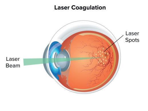 Other forms of treatment are also available for macula oedema related to RVO. These may include treatment with a conventional or hot laser (only suitable for cases of BRVO and not CRVO).