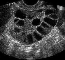 Is ultrasound helpful in distinguishing normal puberty and PCOS?