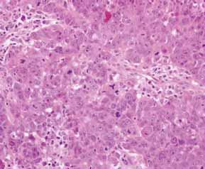 TN and Basal-Like Carcinomas BRCA1