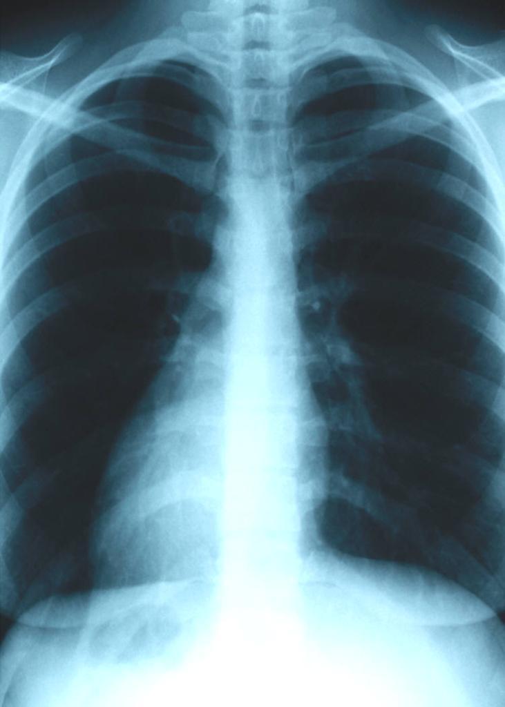 The Problems with CF Lungs Obstruction