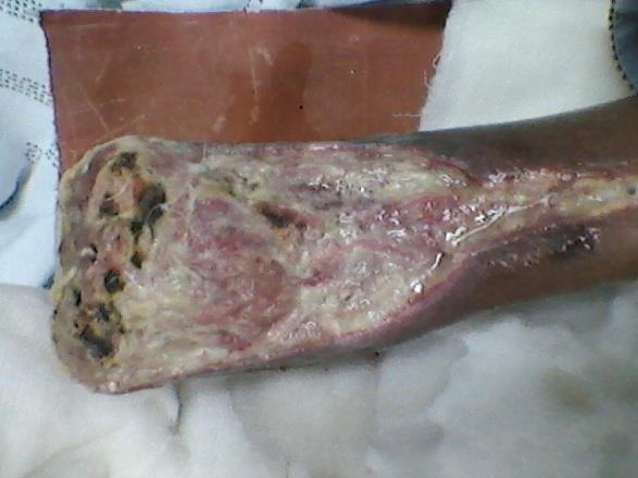 Figure 6. Showing a case s/p debridement and amputation. Note the wound is still infected. Surgeon factor 2 + forefoot amputation 4 + ulcer 6 = 12, rendering patient to moderate risk for amputation.