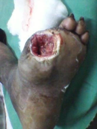 The scoring would be surgeon factor 2 + forefoot ulcer 2 + involvement of forefoot and midfoot charcot 4 = 8, rendering it for low risk for major amputation.