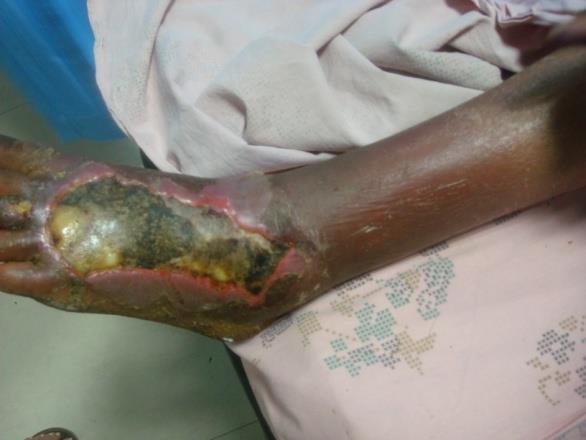 Figure 10. Showing a patient with necrotising infection over the left foot.
