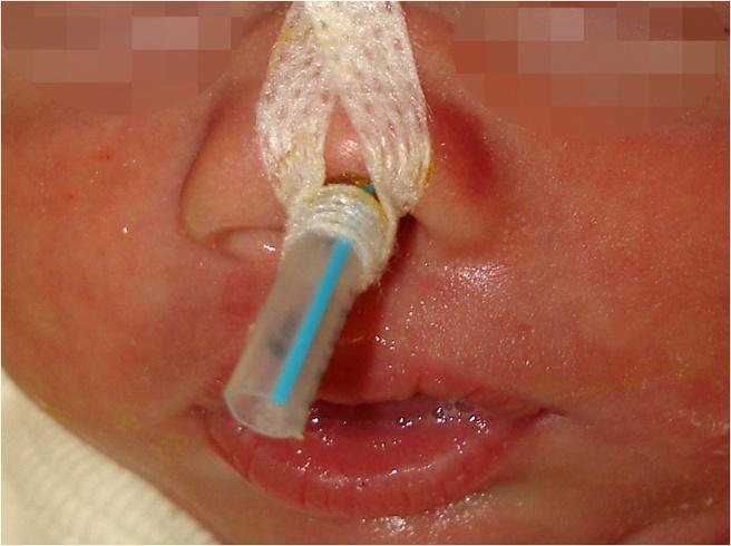 Günther et al. Journal of Medical Case Reports 2014, 8:215 Page 3 of 5 Figure 3 Incorporated 3.00mm tube. A 3.0mm tube was incorporated in the left nasal cavity to achieve sufficient breathing.