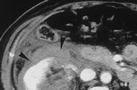 injury of the R-kidney CT demonstrates a large