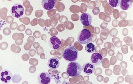 Slika 1. Periferni razmaz krvi kod hronične mijeloidne leukemije. Povišen broj leukocita i trombocita.