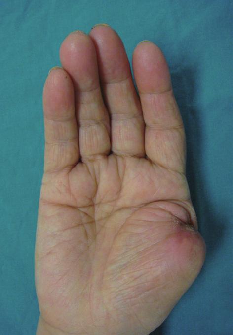 She has suffered from a crushing injury in her right thumb 2 years ago. She had been underwent stump plasty with excision and nail extraction repetitively at a local clinic.