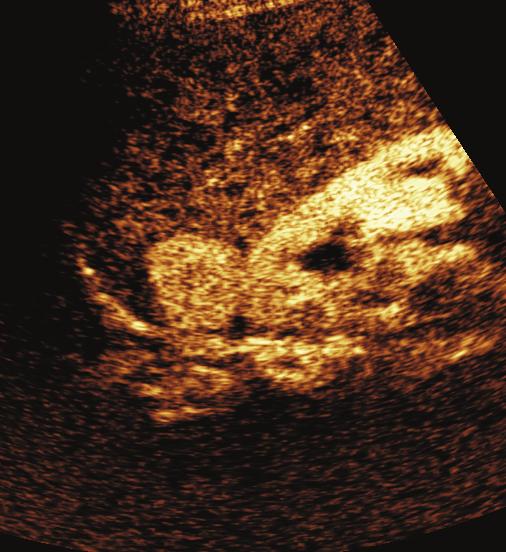 Final diagnosis: Hepatocellular carcinoma (HCC) The contrast-enhanced ultrasound (CEUS) allows to represent in real time the vascularization dynamics of lesions, parenchyma and blood vessels.