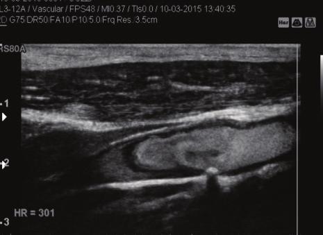 In the US B-mode examination (), the internal carotid artery in the post-bulbar part reveals