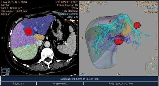 Tumor removal Hepatectomy and local resection: Portal and liver anatomic variations