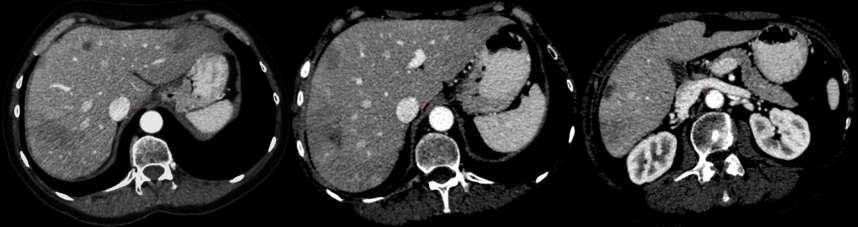 Patient management Case of colon cancer recently removed Bilateral metastases predominant on right lobe Right hepatectomy appears to be feasible after portal vein