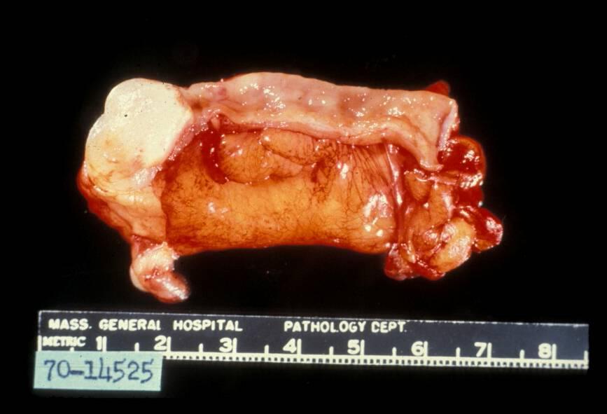 Appendiceal Carcinoids Most common tumor of the appendix Found in 0.