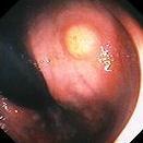 RECTAL CARCINOIDS Usually asymptomatic - discovered at flex sig Yellow, subcutaneous collar button Carcinoid syndrome