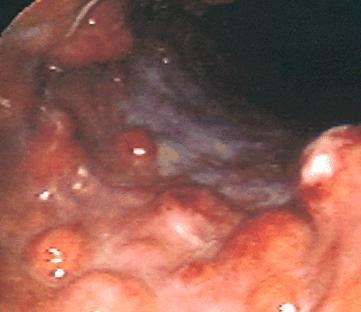 TYPE 1 GASTRIC CARCINOIDS (75%) Develop in