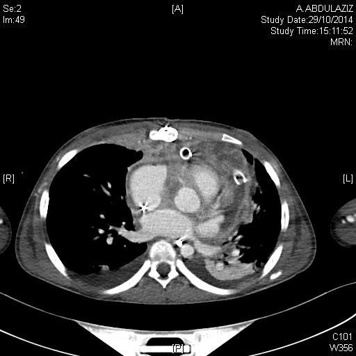 Missed clue: Wide superior mediastinum on chest X ray Diffuse Large B-cell