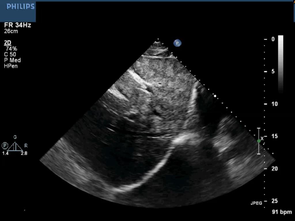 Echocardiography was requested because of chest pain No significant cardiac pathology Subcostal views showed