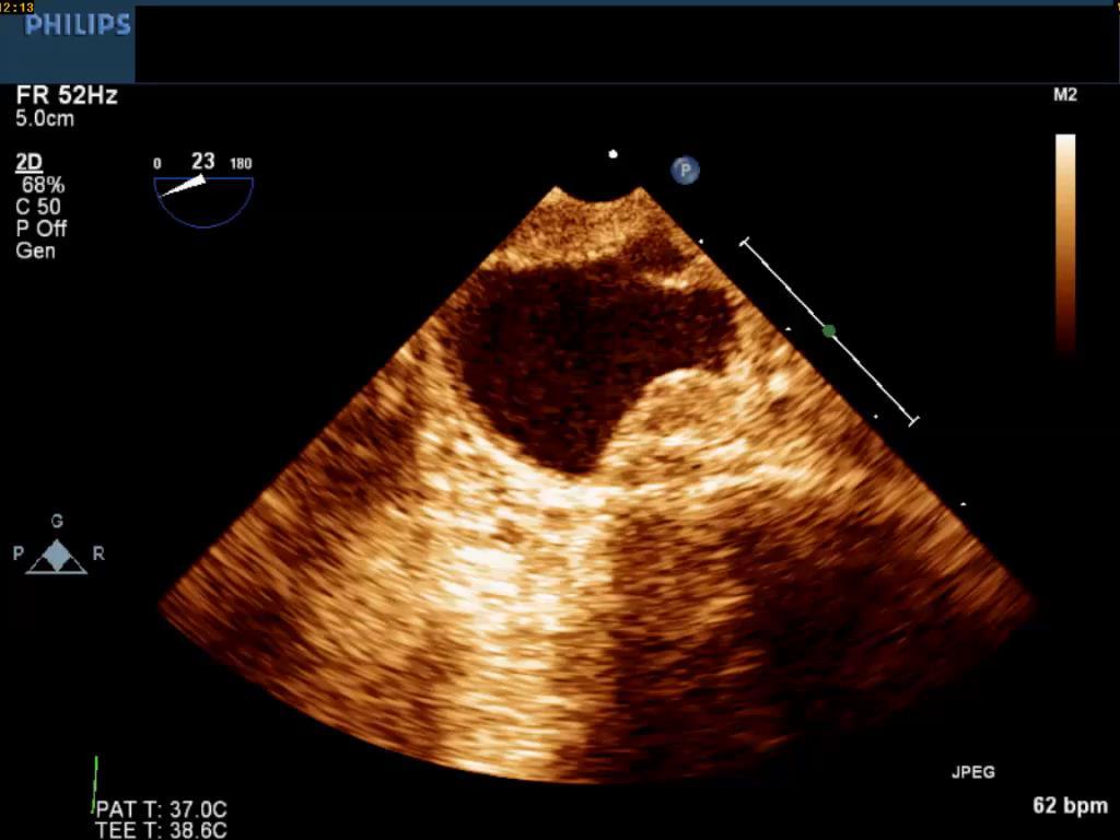 Case 7 78 male HTN, DM and known case of ischemic heart disease Post PCI to LAD