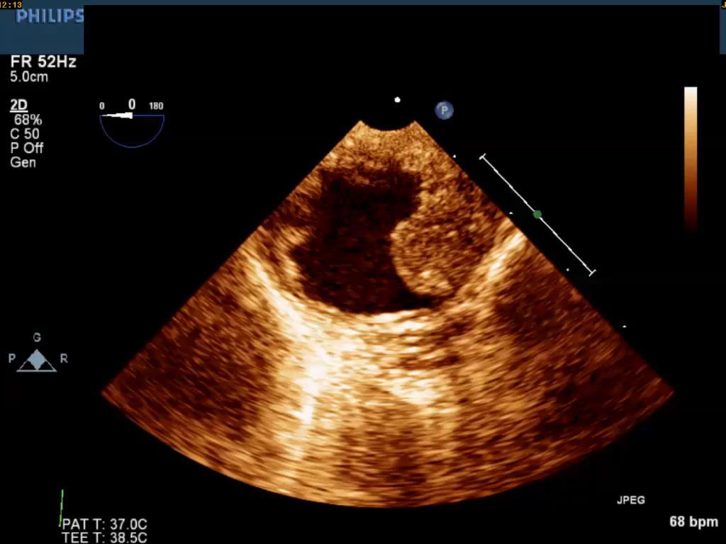 TEE requested to assess the severity of mitral regurgitation.