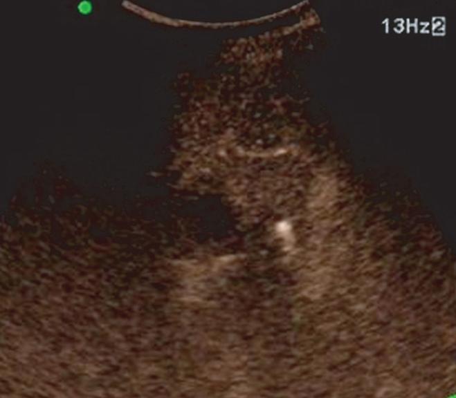 Ryu SW, et al: Contrast Enhanced Ultrasonography for the Diagnosis of Liver Masses 293 of SonoVue CEUS, and to compare this method with CT and MRI for the evaluation of liver masses.