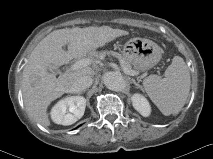 A CEUS examination was considered conclusive for diagnosis if the focal liver lesion (FLL) had a typical enhancement pattern after contrast injection during arterial, portal and late phases,