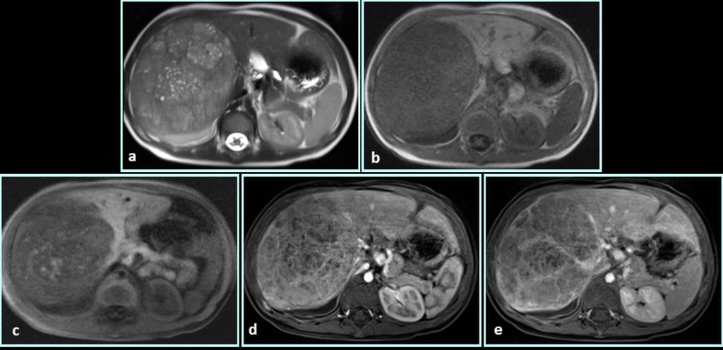 Fig. 2: Hepatoblastoma: large liver lesion in a 3 year-old child showing moderate heterogeneous high signal on T2-weighted images with dispersed intralesional cystic areas (a) and low signal on