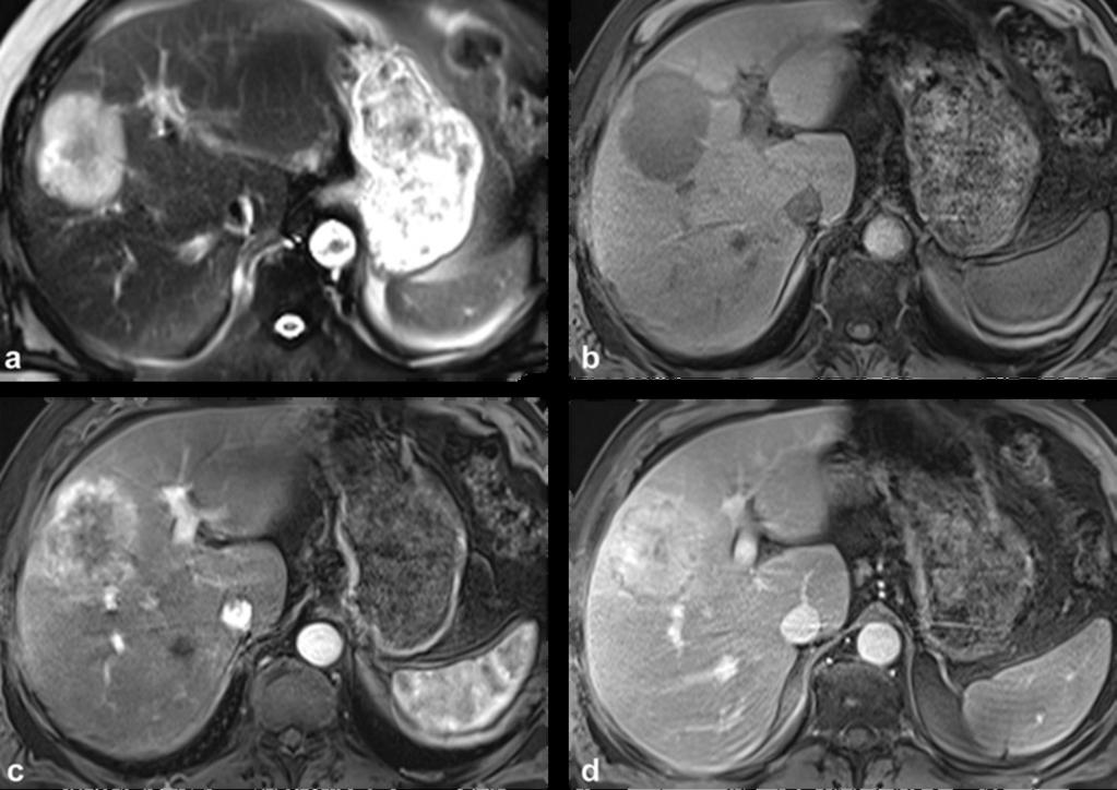 Fig. 3: Mixed HCC-Cholangiocarcinoma in 58-year-old man: The lesion is heterogeneously hyperintense on T2-weighted fat-suppressed images (a) and hypointense on pre-contrast fat-suppressed T1-weighted
