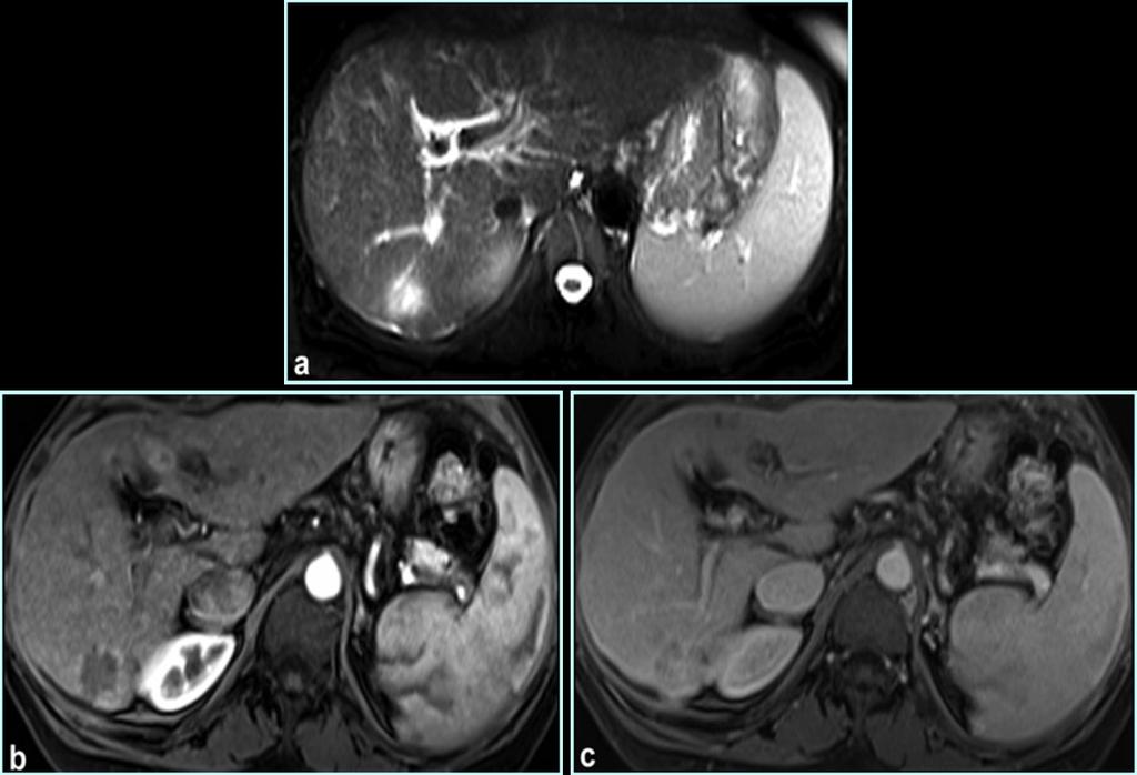 Fig. 4: Mixed HCC-Cholangiocarcinoma in a 55-year-old woman hepatitis B and C and cirrhosis: The lesion is hyperintense on fat-suppressed T2-weighted images (a), with