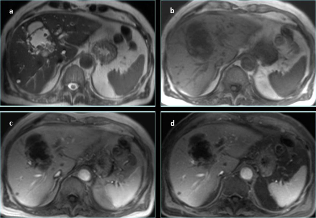 Fig. 5: Biliary cystadenocarcinoma: multiloculated lesion with high signal intensity on axial T2-weighted images (a), and low signal on T1-weighted images before (b) contrast administration.