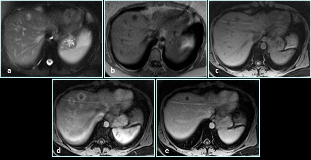 Fig. 7: Multifocal nodular type of epitheloid hemangioendothelioma: the lesions show moderate high signal intensity on fat-supressed T2-weighted