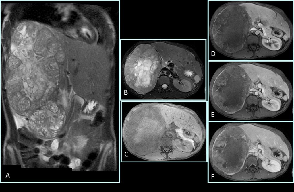 the delayed phase (e) there is progressive filling of the central area. Note minimal mass effect and the presence of portal vein branches encased by the lesion. Fig. 10: Ewing's sarcoma.