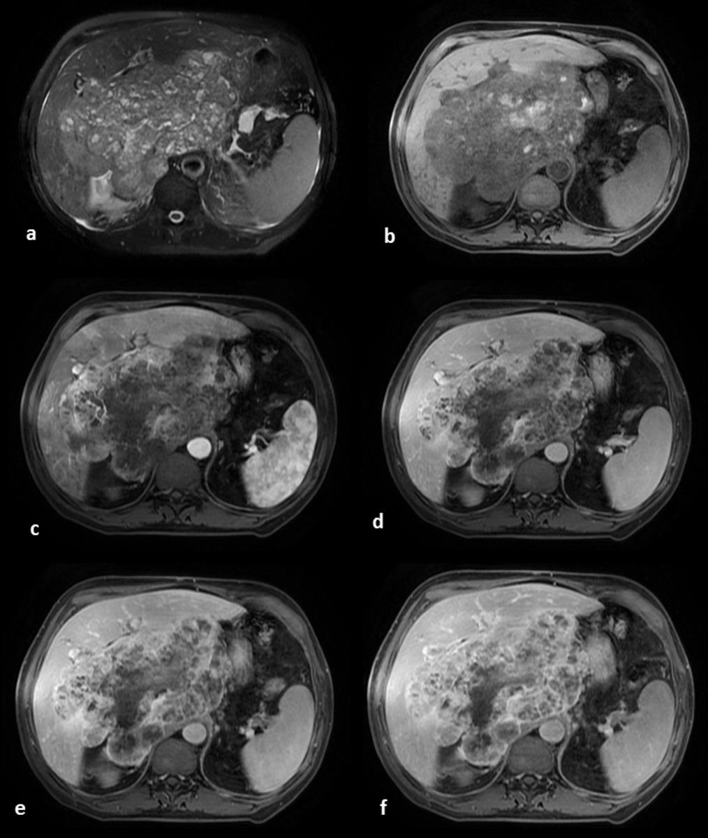 Fig. 11: Hepatic angiosarcoma: the tumor is heterogeneous on fat-suppressed T2weighted images with high signal intensity areas of hemorrhage/necrosis and low intensity areas of hemosiderin