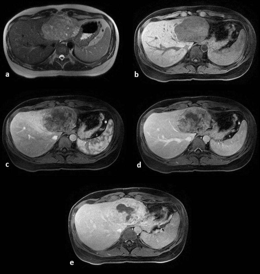 Fig. 12: Primary hepatic leiomyosarcoma: the tumor is heterogeneous with moderate hyperintensity on T2-weighted images (A) and hypointensity on unenhanced fatsuppressed T1-weighted images