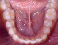 Other than that, a moderate buccal inclination of the lower incisors was