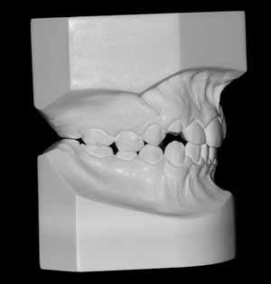 Transverse malocclusion, posterior crossbite and severe discrepancy lower incisors touching the cervical third of the lingual surface of the upper incisors.