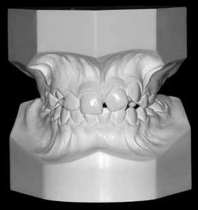 The concave facial profile represented a challenge both due to a high nasal prominence and a significant soft tissue thickness at the chin level.