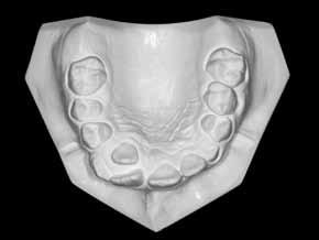 Treatment goals The treatment had as a primary goal the establishment of a better transverse dimension of the maxillary arch by means of skeletal expansion and, consequently to obtain the correction