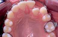 The intention was to avoid retraction of anterior teeth, keeping the lips from retruding.