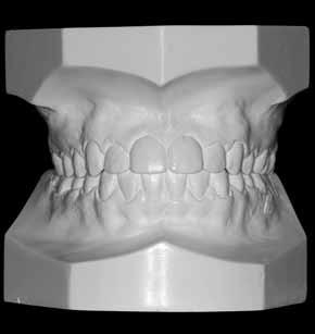 Cephalometric measurements and superimpositions demonstrate a significant mandibular growth, as expected according to the facial profile presented by the patient.