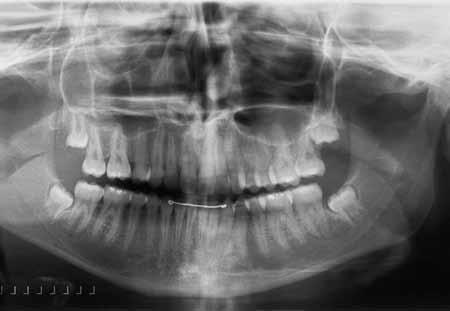 Transverse malocclusion, posterior crossbite and severe discrepancy FigurE 9 - Final