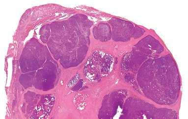 Multinodular pattern of invasion in oncocytic follicular