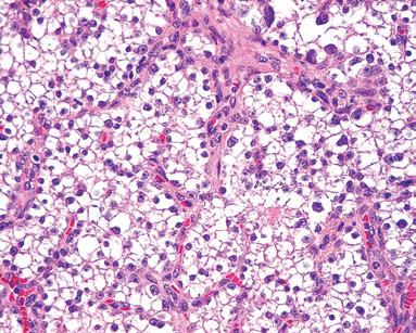 Intrathyroid parathyroid neoplasm simulating a primary thyroid tumour Tumours and hyperplasias