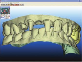 Prior to tooth preparation, the opposing dentition can be scanned by the dental assistant. 4. Assimilation Press the foot pedal again to preview 3D virtual models of both arches on the screen.