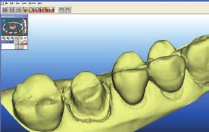 Dentist Dr Bret Jacobson Patient treatment plan Fractured DL cusp on tooth #14 requiring a full-coverage crown Scanning time Opposing arch scanned by dental assistant: 2 min Prepared tooth scanned by